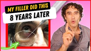 MY UNDER EYE FILLER REACTION 8 YEARS LATER And HOW IM FIXING IT [upl. by Ursuline]