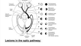 Optic nerve lesions Bitemporal hemianopia heteronymous hemianopiaHomonymous hemianopia [upl. by Cy]