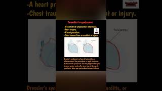 Dressler SyndromeFreeMedicalEducationld3sfmedicalnursingmbbsviralshortsyoutubeviralshorts [upl. by Zurek]