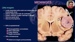 TUMORES DO SISTEMA NERVOSO CENTRAL [upl. by Nivi]