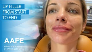 Lip Filler from Start to End [upl. by Monney]