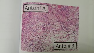 Schwannoma  SPECIAL PATHOLOGY [upl. by Line]