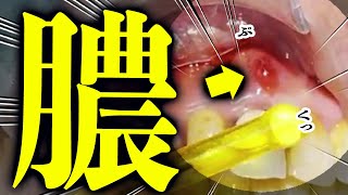 患者「痛いねん」 お口をのぞいたら膿でドロドロになってました 歯医者かおりが治したるねん [upl. by Gaeta480]