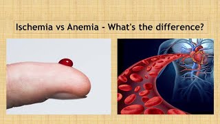 Ischemia vs Anaemia Simple way to learn [upl. by Annoel]