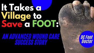 An Advance Wound Care Success Story It Takes A Village To Save A Foot [upl. by Ulane]