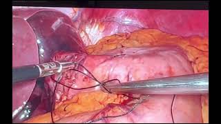 Toupet Fundoplication with Hiatal hernia repair [upl. by Ainevul582]