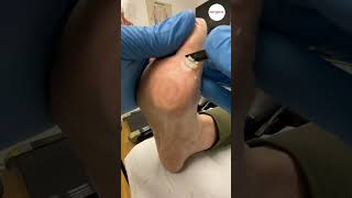 Podiatrist treats wart with acid [upl. by Rebel]