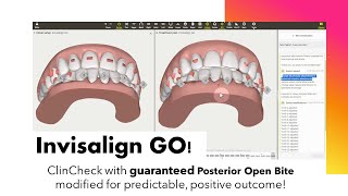 Invisalign GO ClinCheck  A modification to avoid a guaranteed Posterior Open Bite [upl. by Adnoma563]