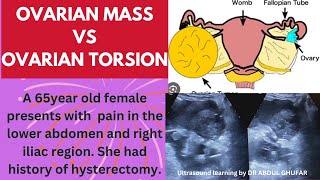 Ovarian cancer ultrasound  ovarian tumour ultrasound  ovarian torsion usg ovarian cancer symptoms [upl. by Kcajyllib]