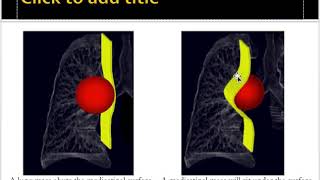 Mediastinal masses approach [upl. by Violetta509]