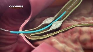 QuickPlaceV Biliary Stent [upl. by Asseralc]