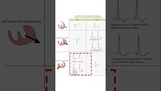 RV Hypertrophy ECG What it Means and How to Spot It दिल का दाहिना भाग बड़ा हुआ है ECG से पहचाने [upl. by Ikkaj]