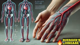 Buergers Disease Thromboangiitis Obliterans Easy Explanation [upl. by Holey]