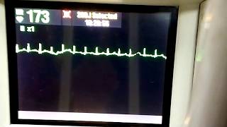 Adenosine diagnostic test during SVT [upl. by Calla508]