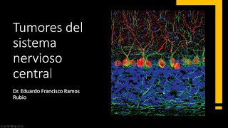 Tumores del sistema nervioso central [upl. by Kciredohr]