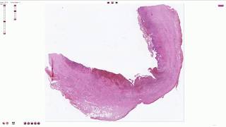 Chronic Cholecystitis with Acute Exacerbation  Histopathology [upl. by Godfrey]