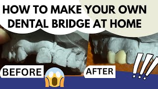 Make your Own DENTAL BRIDGE at home DIY Easy and Realistic Custom made Resin Bridge [upl. by Prakash686]