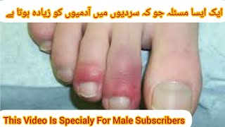 Chilblains Home Remedy For Chilblains Best Creams For Chilblains [upl. by Nosnhoj]