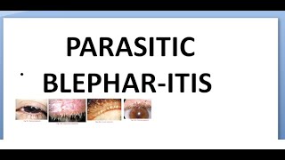 Ophthalmology 371 Parasitic Blepharitis Infestation Lice phthirus pediculosis yellow mercuric oxide [upl. by Adriena]