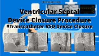 VSD VSD Device Closure Transcatheter VSD Device Closure [upl. by Eenaffit]