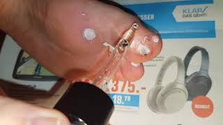 Plantar wart removing part 7 44  Dornwarze entfernen Teil 7 44 [upl. by Tereb144]