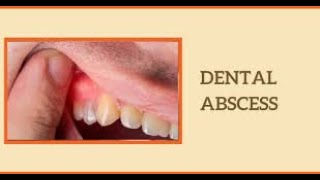 Understanding Dental Abscess Causes Symptoms and Treatment shorts youtubeshorts [upl. by Yadnil]