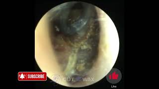 Narrow Ear Canal Makes Ear Wax Removal Harder  Out With The Wax [upl. by Herahab328]