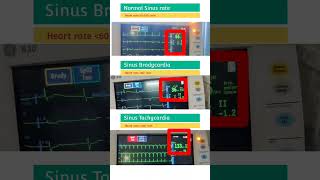 Normal Heart rate l Sinus Bradycardia l Sinus Tachycardia shorts [upl. by Acsehcnarf]