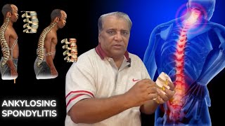 Kia back pain itni khatarnak bhi ho sakti he Ankylosing Spondylosis [upl. by Salohcin820]