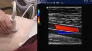 How To Lower Extremity Arterial Duplex Exam [upl. by Gerson]