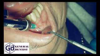 Infiltration anesthesia for treatment 3334 tooth [upl. by Honna]