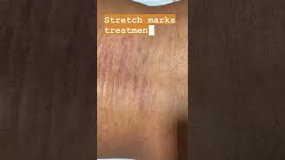 Stretch mark removalstretch mark removal laserdermatologist surat [upl. by Keeton]