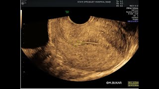 SMALL ENDOMETRIAL POLYP [upl. by Sauncho]