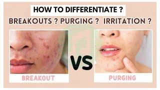 How To Know If Your Skin Purging Or Breaking Out✨Breakouts Vs Purging Vs Irritation ✨ [upl. by Mikeb375]