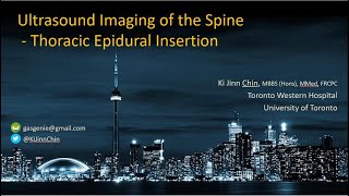 Ultrasound Imaging for Thoracic Epidural Insertion [upl. by Tayyebeb856]