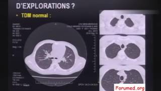 Cas Cliniques en images sur la fibrose pulmonaire idiopathique et pneumopathie [upl. by Soloma]