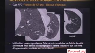 Imagerie des pneumopathies et Fibrose Pulmonaire [upl. by Ettelegna]