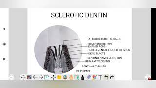 sclerotic dentin dental histologyDADH [upl. by Noisla]