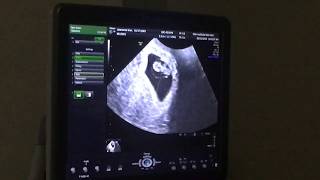 Hearing our baby’s heartbeat 💗 2nd UltrasoundIUI Success [upl. by Judi]