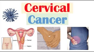 Cervical Cancer Risk Factors Pathophysiology Symptoms Staging Diagnosis Treatment amp Prevention [upl. by Ecyle51]