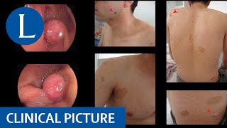 Neurofibromatosis type 1 and a gastrointestinal tumour [upl. by Evan]