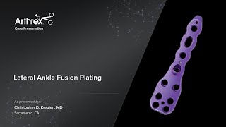 Lateral Ankle Fusion Plating [upl. by Maxima]