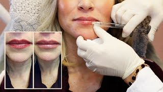 30 Units of Botox  Lip Filler from Doctor Cynthia Cote [upl. by Katherin986]