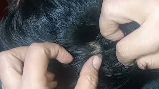 Scalp Check Real Person  Lice And Nits Checking ASMR  Mousaasmr830 [upl. by Barber]