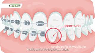 Fluocaril Ortho123 หนูด่าง 30 sec [upl. by Harifaz]