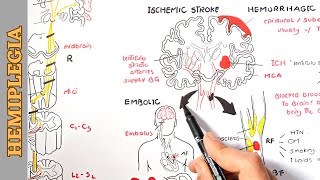 Hemiplegia part 1  causes pathophysiology stages and manifestations [upl. by Eelanna]