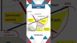 Triangle of doom  Hernia surgery basics surgicaleducation neetpg anatomyclass [upl. by Cyrano485]