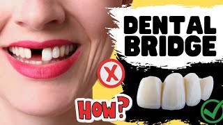 Dental Bridge Procedure for Missing Teeth  IN DEPTH Review of Risks amp Benefits [upl. by Kemppe]