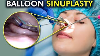 Balloon Sinuplasty Unveiled A Painless Path to Clear Sinuses 3d Animation [upl. by Cykana641]