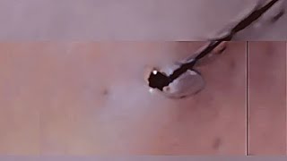 Removal of ingrown hair [upl. by Lianna]